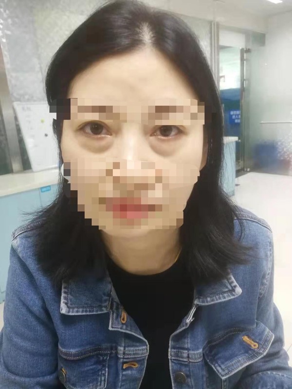 眼袋術前.jpg