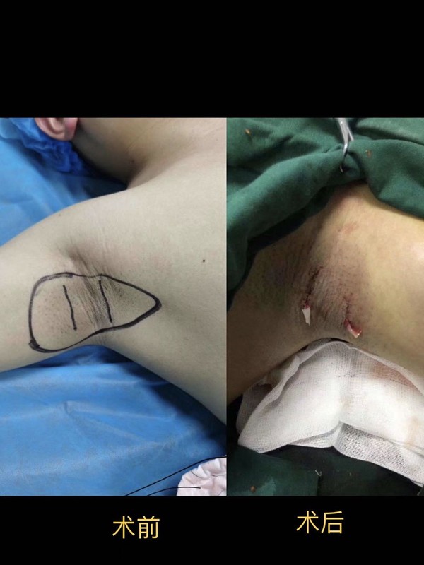 腋臭微創術.jpg