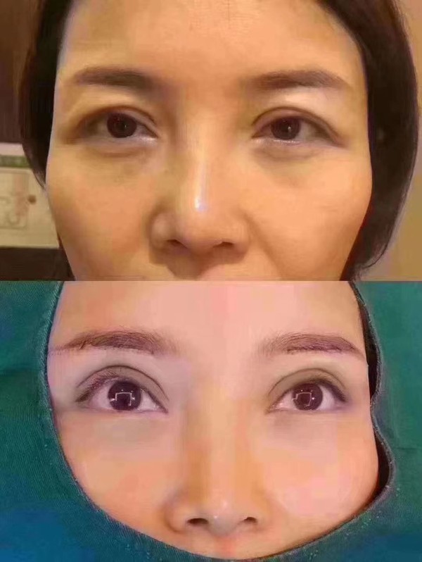 重瞼術.jpg